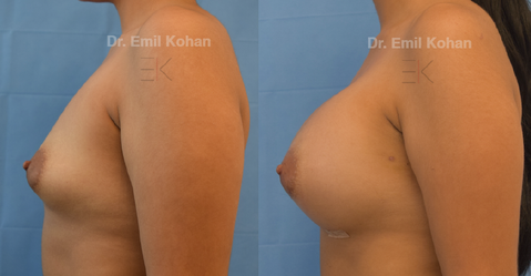 Breast Augmentation
