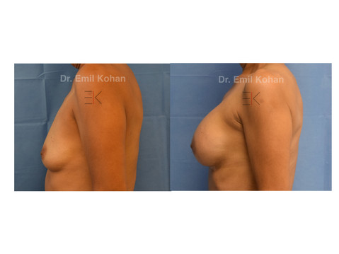 Breast Augmentation