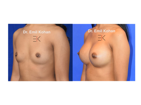 Breast Augmentation