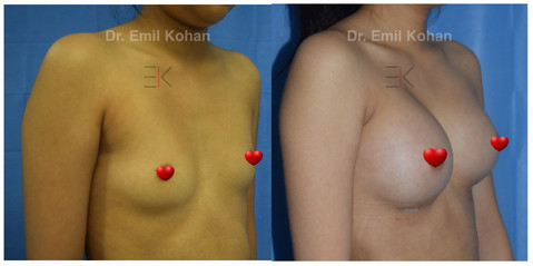Breast Augmentation