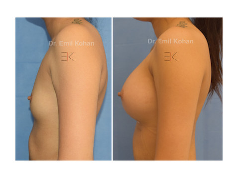 Breast Augmentation
