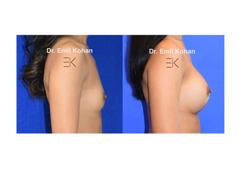 Breast Augmentation
