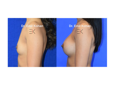 Breast Augmentation