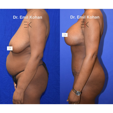 VRiley before after Mommy makeover.003.j
