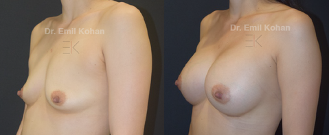 Breast Augmentation