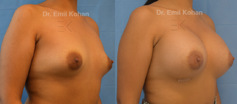 Breast Augmentation