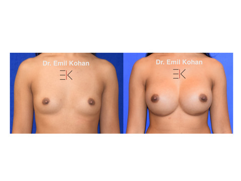Breast Augmentation