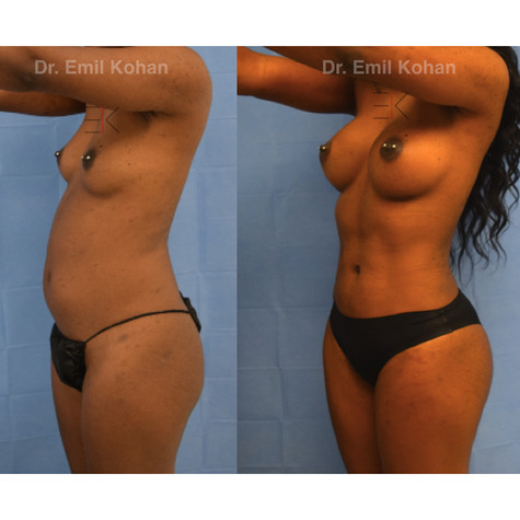 Liposuction