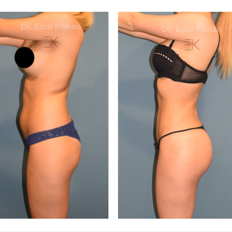 Body Transformation