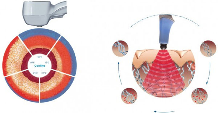 exilis-cross-section.jpg