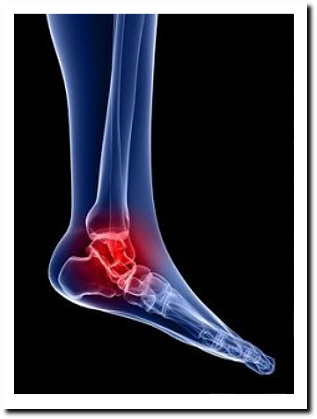 Ankle Injuries