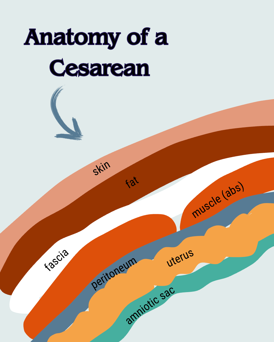 drawing of the layers and tissues that make up the anatomy of a cesarean: skin, fat, fascia, muscle, peritoneum, uterus, amniotic sac