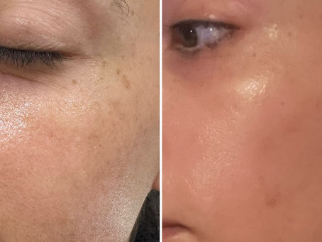 Revitalize Your Skin at North Shore Laser Center: Combating Sun Damage with Advanced Technology