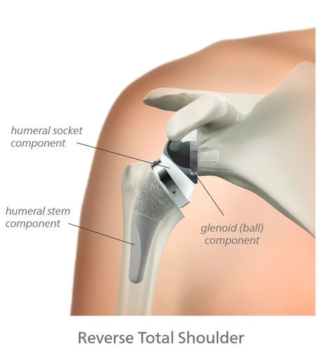 Reverse Shoulder Replacement