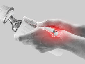 Base of Thumb Joint Replacement: 
