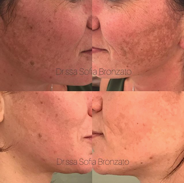 Macchie acne peeling