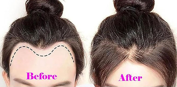 Hairline-before-after