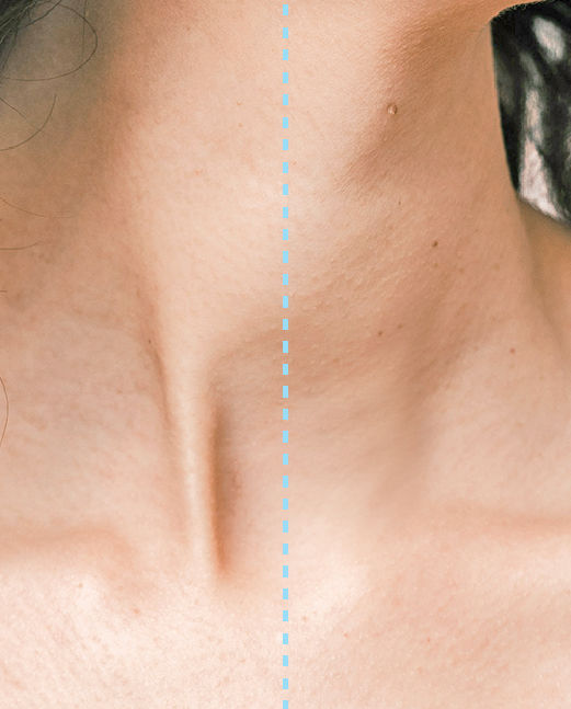 สำเนา platysmal-botox.jpg