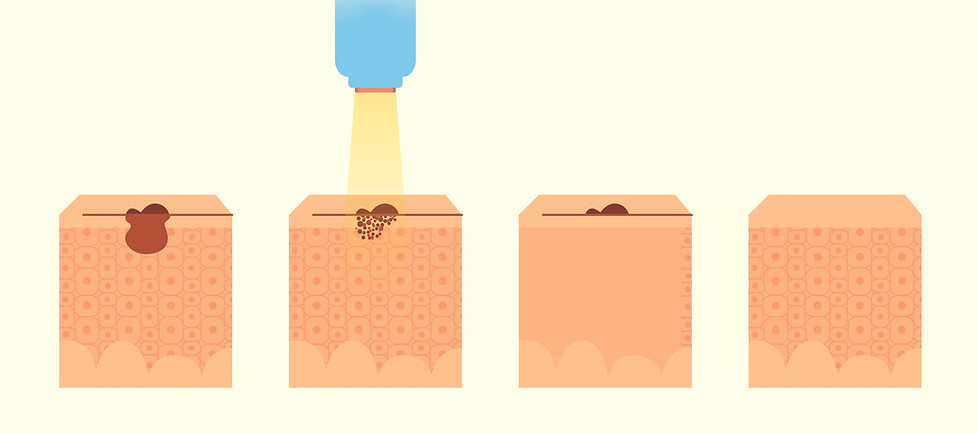 rederm_pico illustration.jpg