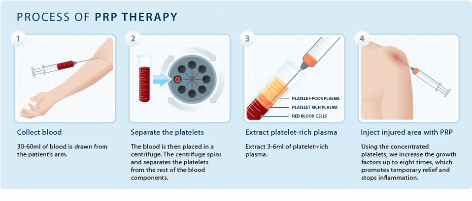 Platelet_Rich_Plasma_PRP-Therapy.gif