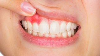 periodontitis-nedir.jpg