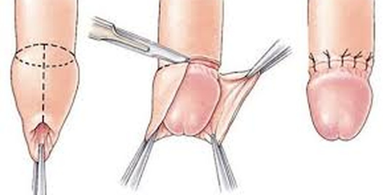 fimose dicas e cuidados apos cirurgia