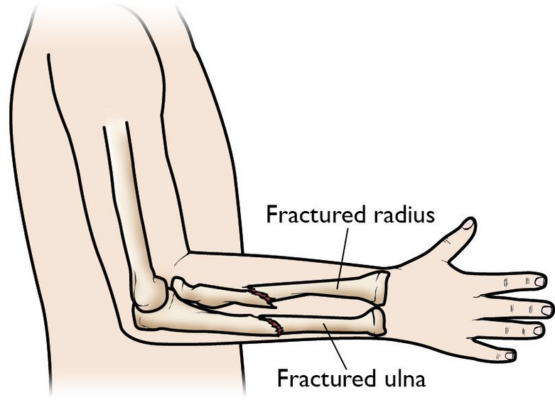 "MY CHILD BROKE THEIR FOREARM! WHAT NOW?" AN OVERVIEW OF BOTH BONE