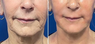 Side by side before and after 