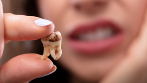 Tooth removed after tooth decay