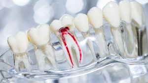 Root Canal treatment - nerve pain in your tooth