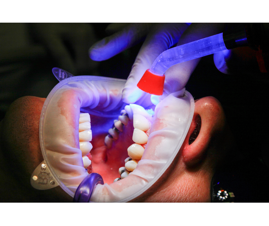 setting composite fillings
