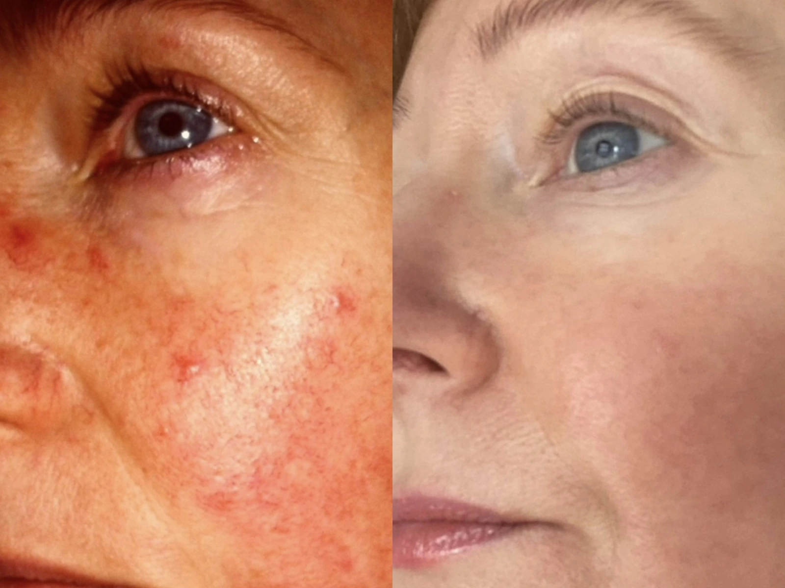 Wang met rosacea vóór en na drie behandelingen met IPL Lumenis M22, met links de beginsituatie en rechts het resultaat.