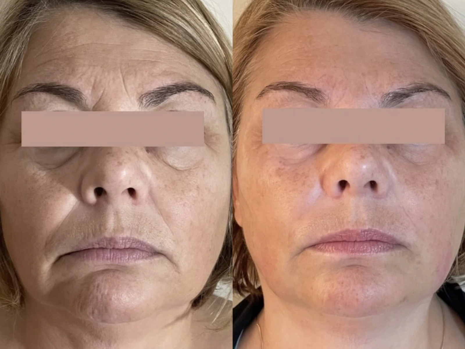 Gezicht vóór en na een ResurFX M22-laserbehandeling, met voorhoofd, wangen en mondzone in beeld en bestaande afscherming van de ogen.