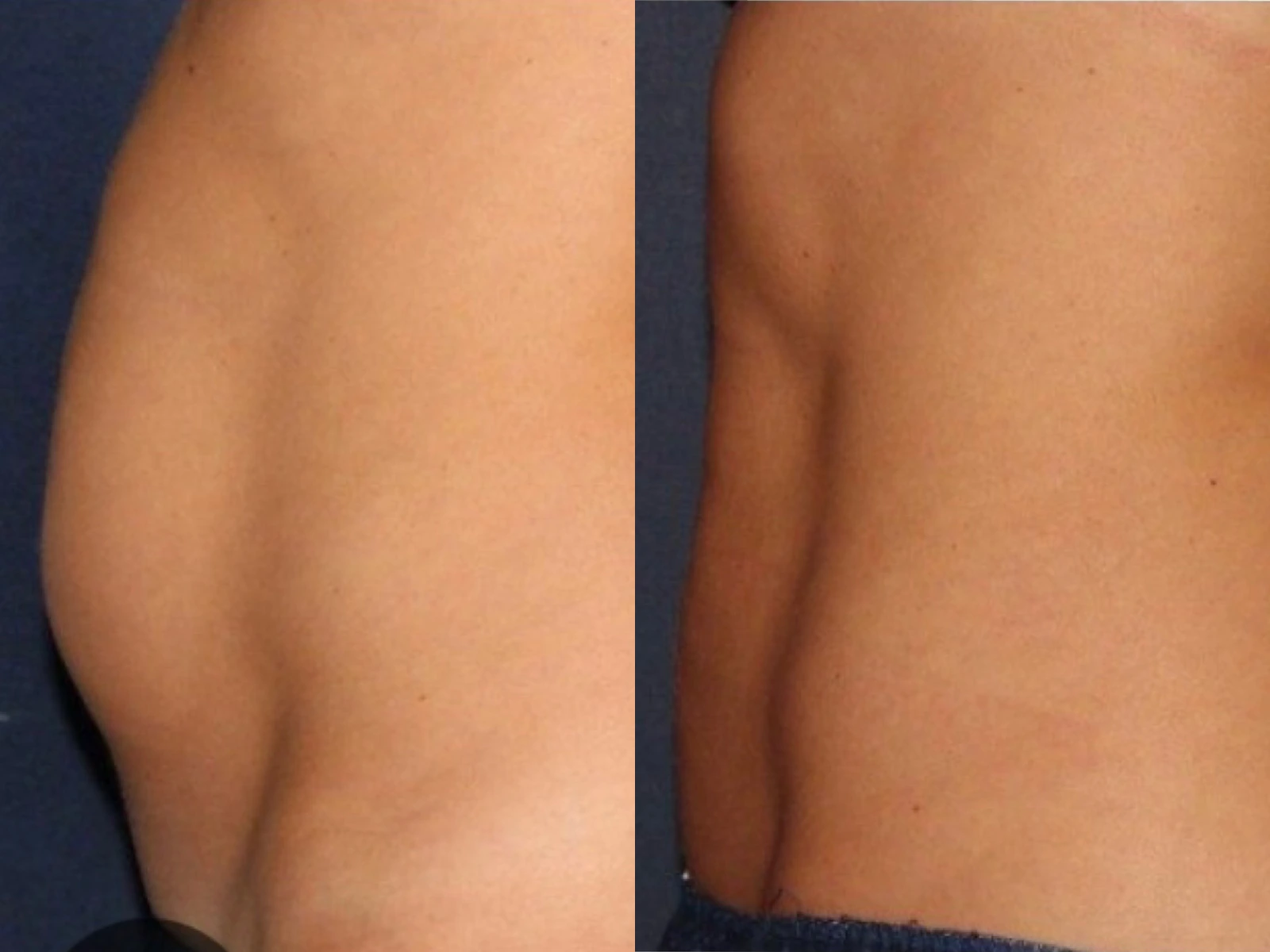 Buik in zijaanzicht vóór en na EM Body Sculpting met HI-EMS, met links de beginsituatie en rechts een vlakkere buikcontour.