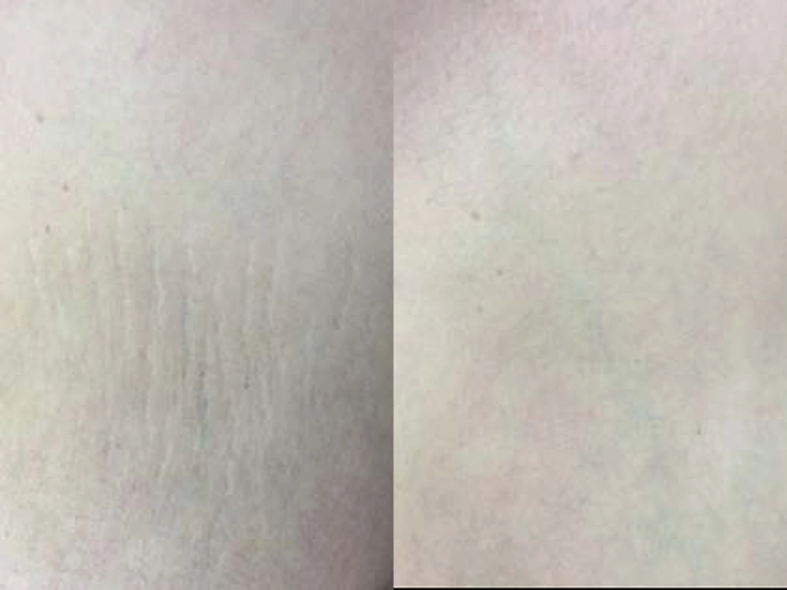 Striae op het lichaam: links de beginsituatie en rechts de na-opname. Voorbeeld van Beauty & Mind · Lumenis-beeldbank.