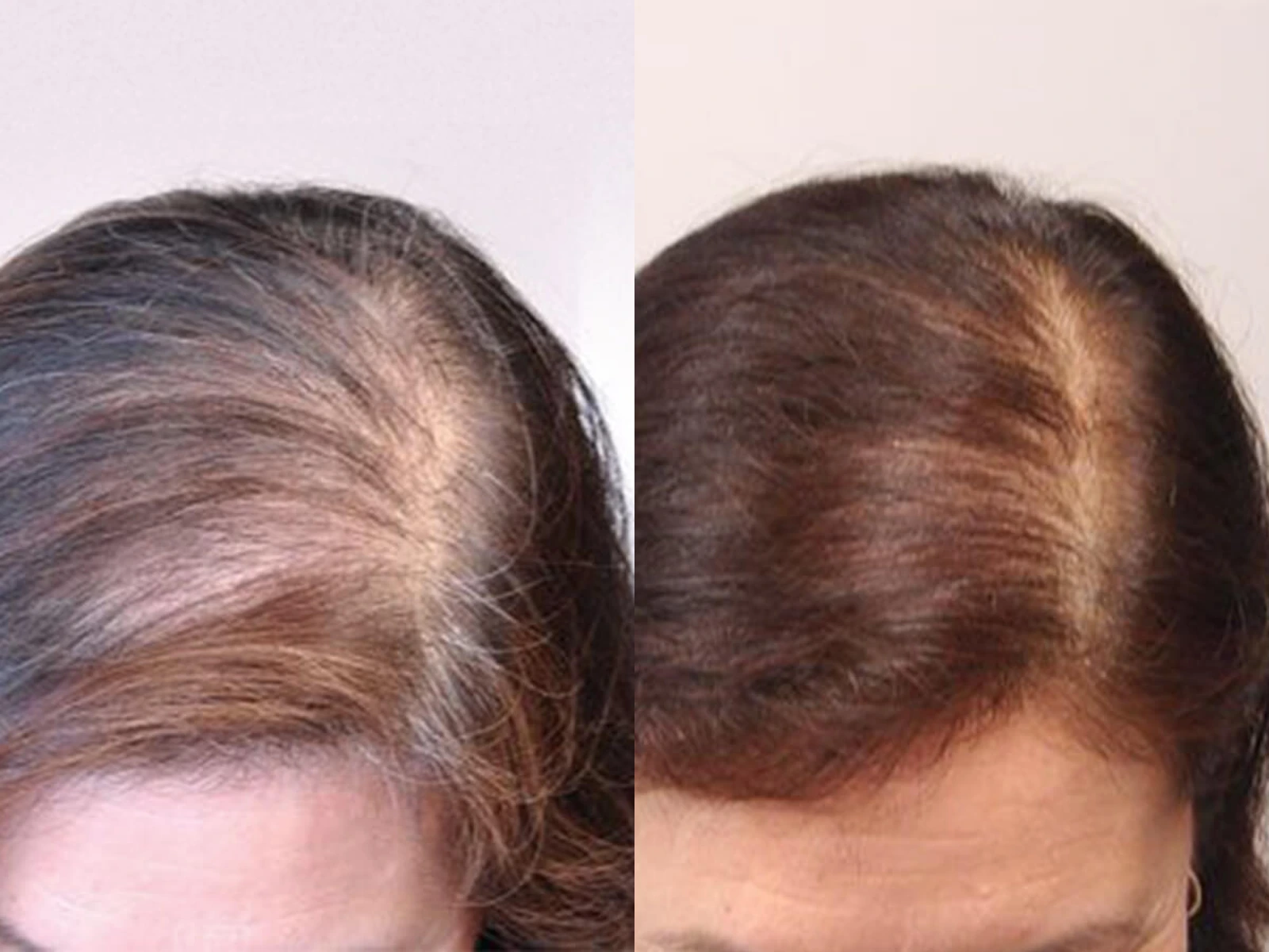 Twee opnamen van de haarscheiding, met links meer zichtbare hoofdhuid tussen de haren en rechts een voller ogende haarbedekking.