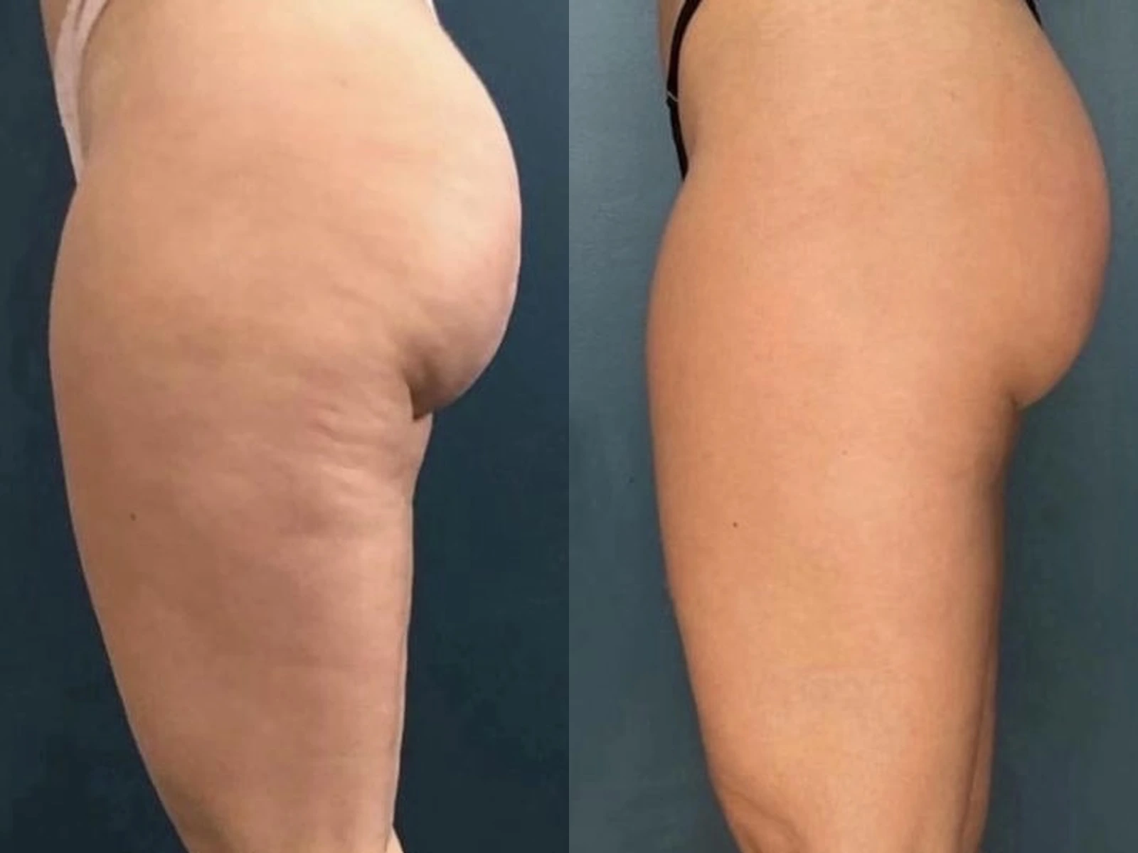 Billen en bovenbenen vóór en na een cellulitebehandeling met Icoone en Endospheres, met links huidkuiltjes en rechts een egalere huidstructuur.