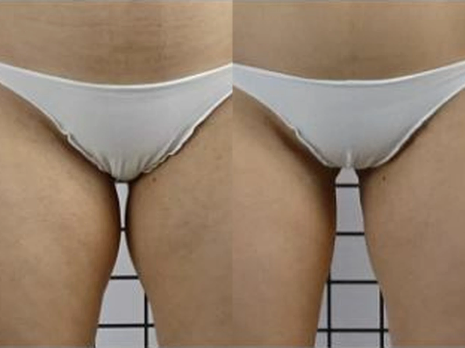 Cellulite aan de binnenkant van de benen vóór en na Icoone lichaam, met links de beginsituatie en rechts de na-opname.
