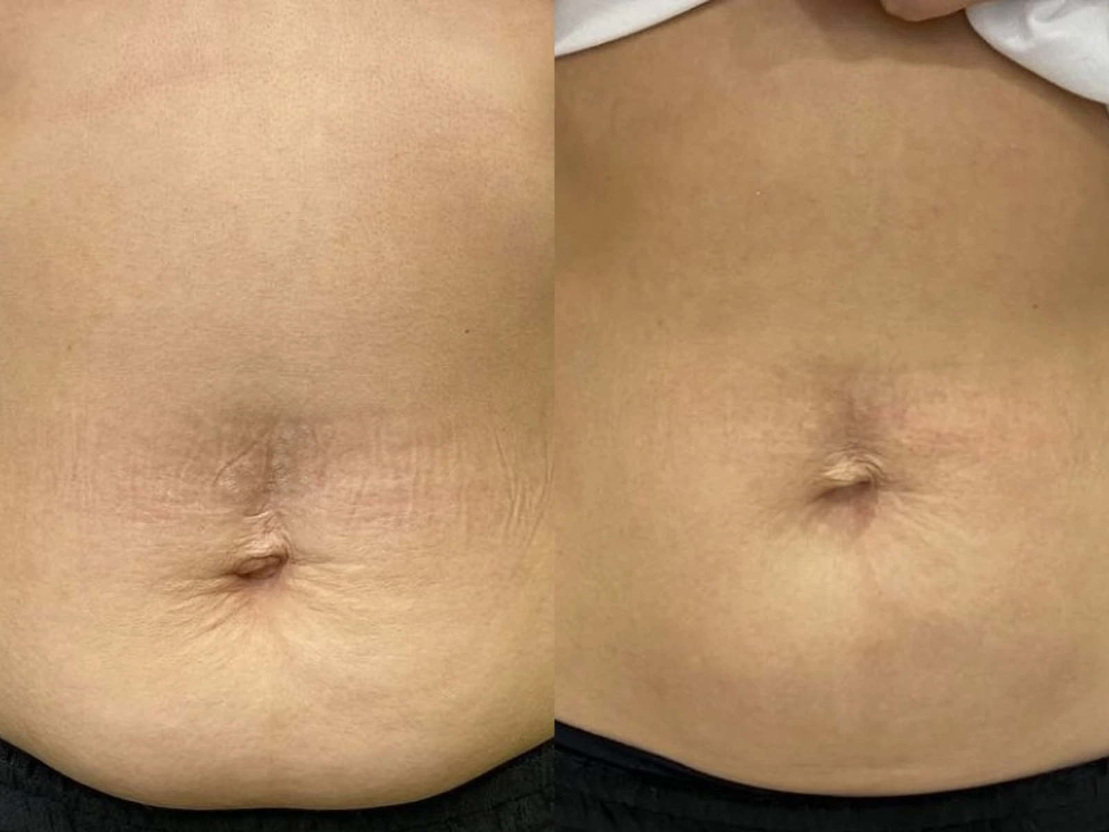 Spierversteviging van de buik vóór en na HI-EMS Body Sculpting, met links de beginsituatie en rechts de na-opname.