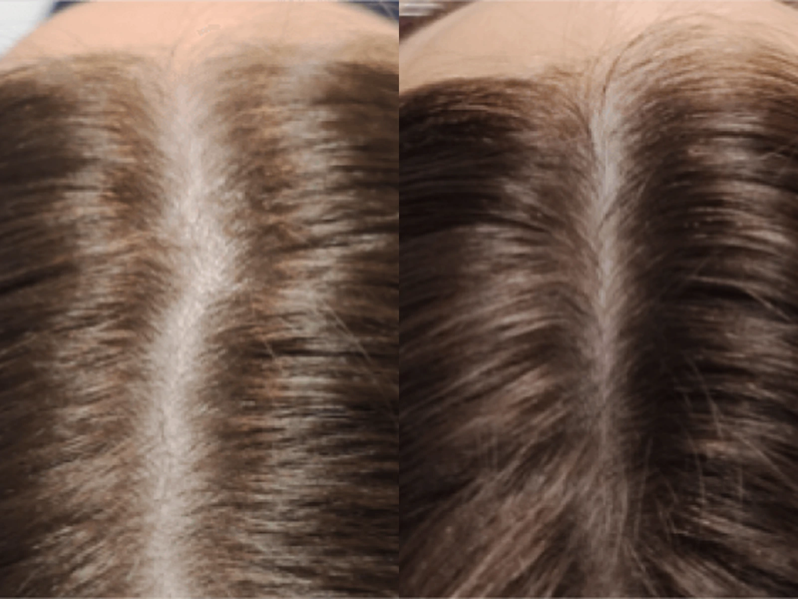 Een breder wordende haarscheiding vóór en na Haargroeistimulatie, met links de beginsituatie en rechts de na-opname.