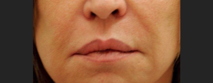 Voor en na Ultraformer: neuslippenplooien