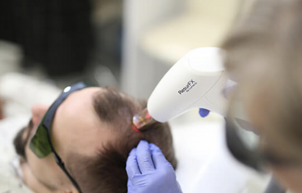 Haargroeistimulatie bij een man: laserbehandeling van de hoofdhuid