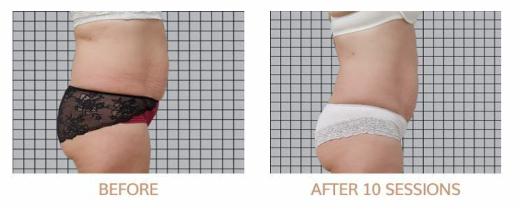icoone®-buik-taille-voor-na-10-sessies-beauty-mind.jpg