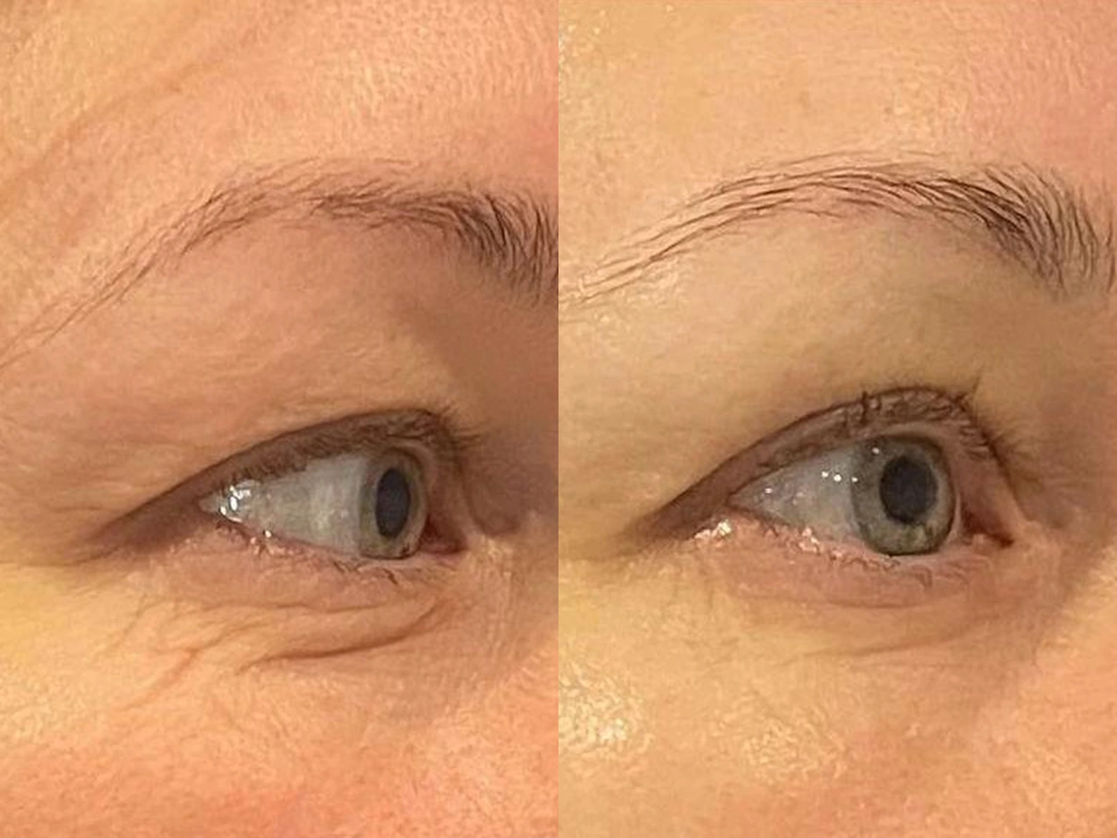 Dezelfde oogzone vóór en na SMAS-lifting, met wenkbrauw, bovenooglid en de huid onder het oog naast elkaar in beeld.