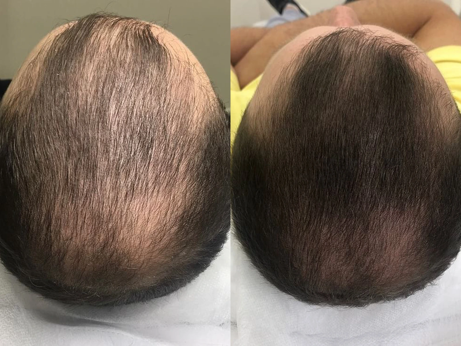 Kruin met dunner haar vóór en na haargroeistimulatie, met links meer zichtbare hoofdhuid en rechts een voller ogende haarbedekking.