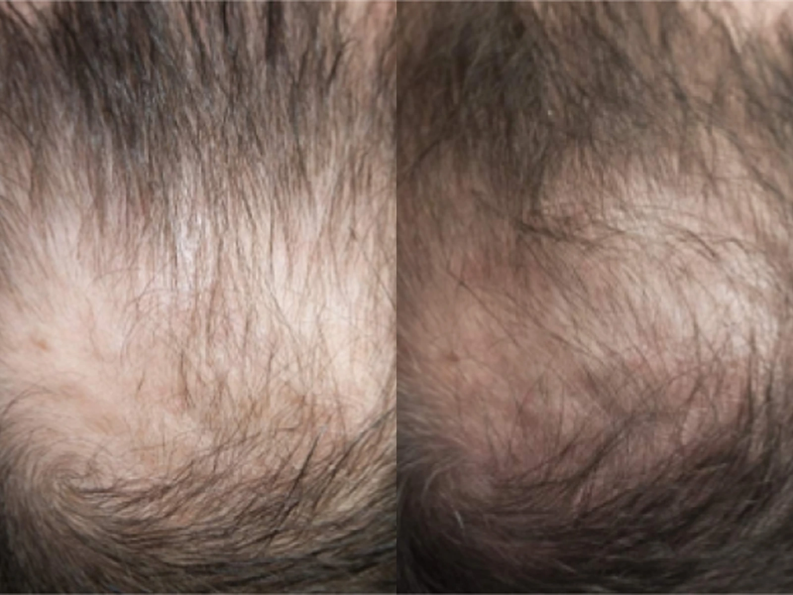 Verminderde haardichtheid op de kruin vóór en na Haargroeistimulatie, met links de beginsituatie en rechts de na-opname.