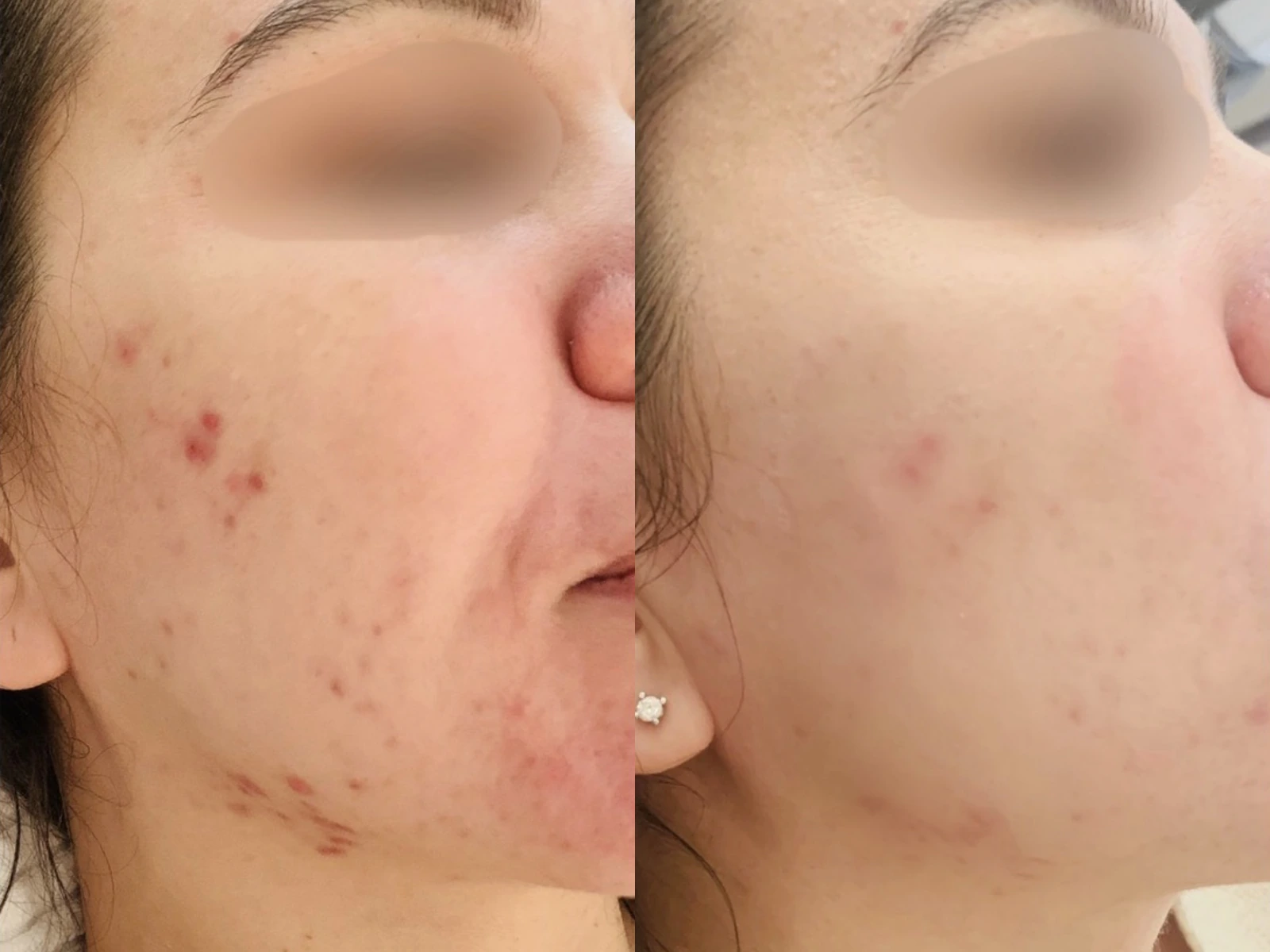 Acne op de wang en kaaklijn vóór en na behandeling, met links meer rode puistjes en rechts minder zichtbare onzuiverheden.