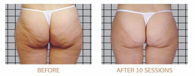 icoone®-cellulite-voor-na-10-sessies-beauty-mind.jpg