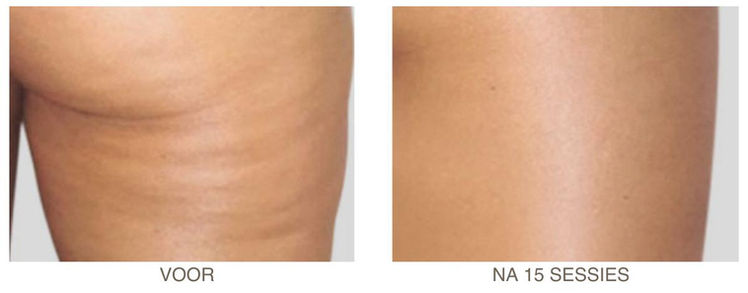 Thigh before and after 15 Endospheres® sessions