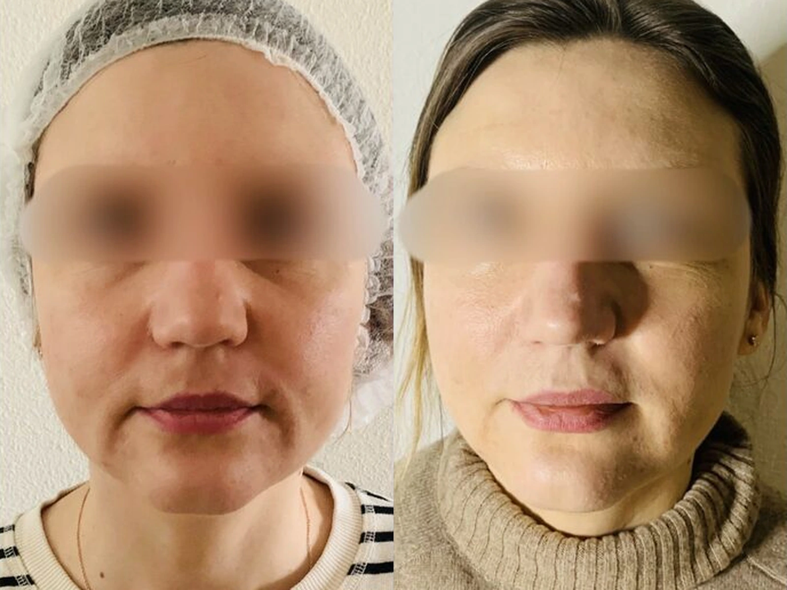 Gezicht in vooraanzicht vóór en na Ultraformer SMAS-lifting, met voorhoofd, wangen en kaaklijn in beeld en bestaande afscherming van de ogen.